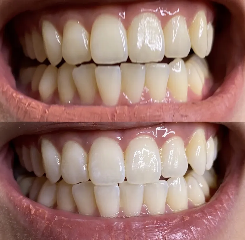 Bright white smile after teeth whitening